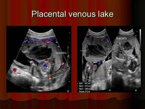 Placental lakes Intervillous thrombosis Insignificant unless found in ...