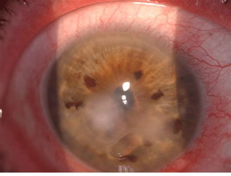 Perikeratic hyperaemia with stromal keratitis. | Download Scientific ...