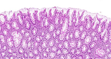 Colon Polyp Histology