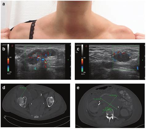 Cervical Lymph Nodes Ultrasound | Images and Photos finder