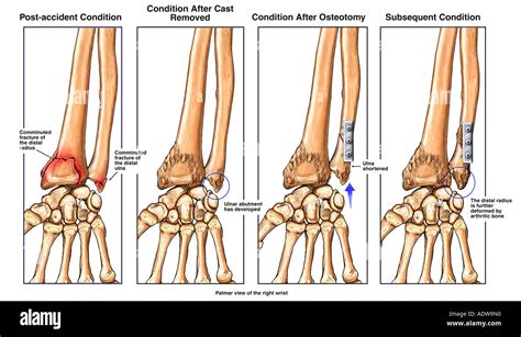 Ulna Wrist Fracture