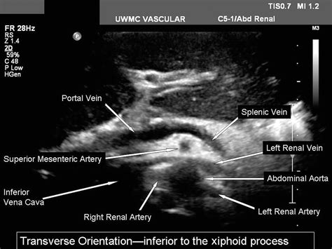 Renal Duplex Scanning | Thoracic Key