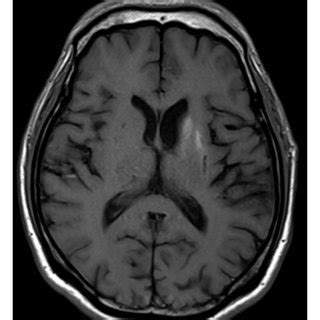 MRI changes in the left corpus striatum related to hemichorea ...