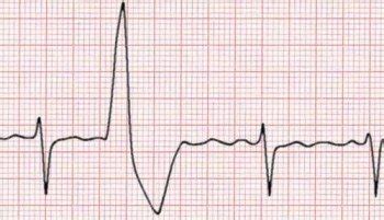 Heart Palpitations | Irregular Heartbeat Explained