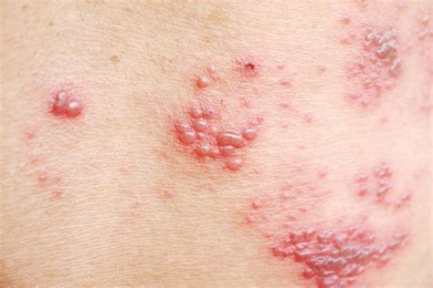 What Are Shingles? A Closer Look at the Reality of Shingles | The Healthy