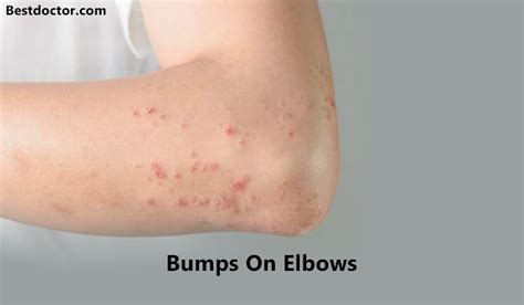 Non Itchy Bumps On Elbows