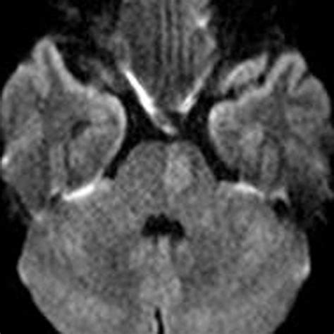 Diffusion-weighted MRI shows a pontine infarction. MRI = magnetic ...