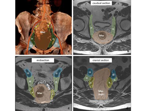 Overview of pelvic lymph node stations on MRI (a) with corresponding ...