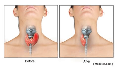 Thyroid Cancer Surgery: Procedure, Risks and Associated Complications