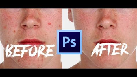 How To Remove Pimples With Only One Tool In Adobe Photoshop! Tutorial ...