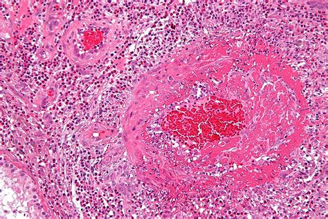 ANCA Vasculitis & ANCA Associated Vasculitis Symptoms, Treatment