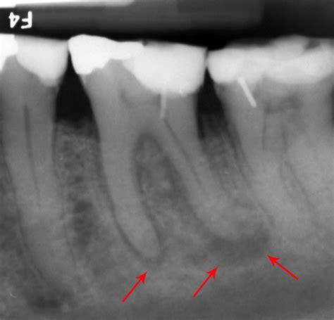 Gum abscess facts | General center | SteadyHealth.com