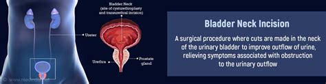 Bladder Neck Incision - Indications, Types and Complications