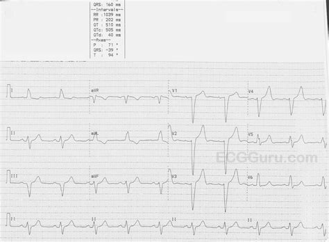 Left Bundle Branch Block | ECG Guru - Instructor Resources