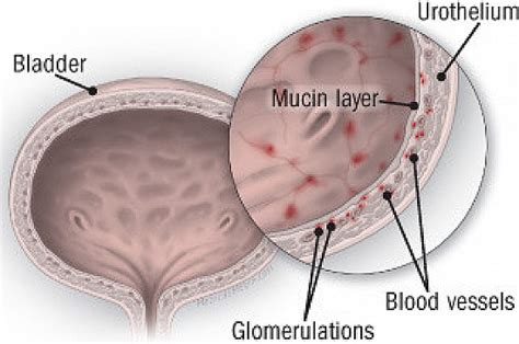 Interstitial Cystitis - Harvard Health