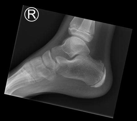 Calcaneus Bone X Ray