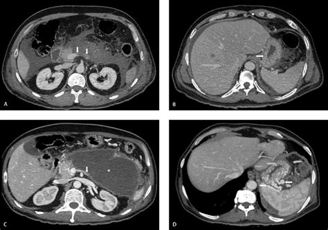 Axial CECT sections of the abdomen. One month prior to presentation (A ...