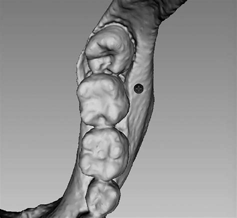 Occlusal drawing of left mandibular buccal shelf. A miniscrew ...