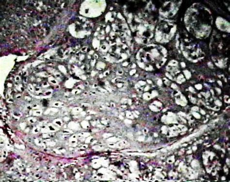 Histology of Chondrosarcoma : Wheeless' Textbook of Orthopaedics