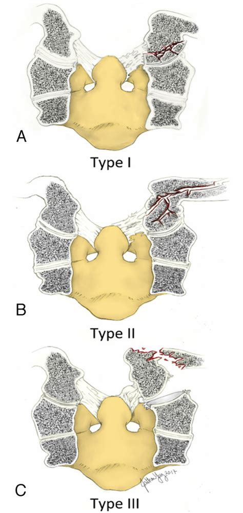 Blunt vertebral artery injury in occipital condyle fractures in ...