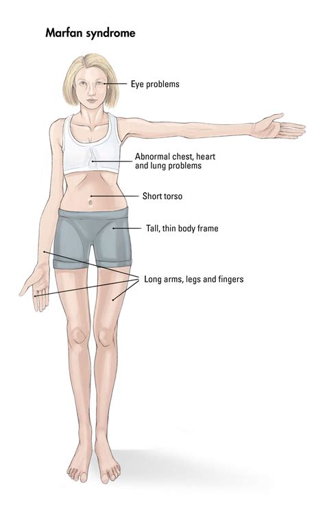 Marfan Syndrome Symptoms In Babies