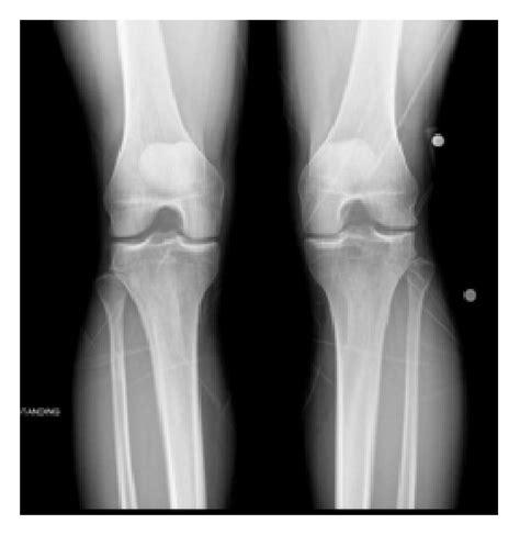 (a) Anteroposterior (AP) and (b) sunrise view of the right knee in a ...