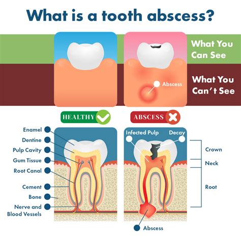 Tooth Abscess Symptoms, Remedies, Complications & Prevention