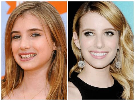 10 Celebrities with Veneers Before and After | Dentgap