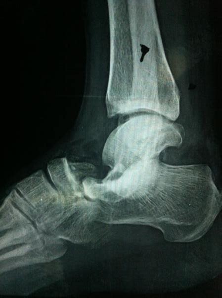 Lateral subtalar dislocation: A case report | The Foot and Ankle Online ...