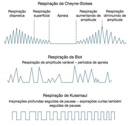 Respiração de Kussmaul, cheyne-stokes e Biot - Consegue Diferenciá-las?