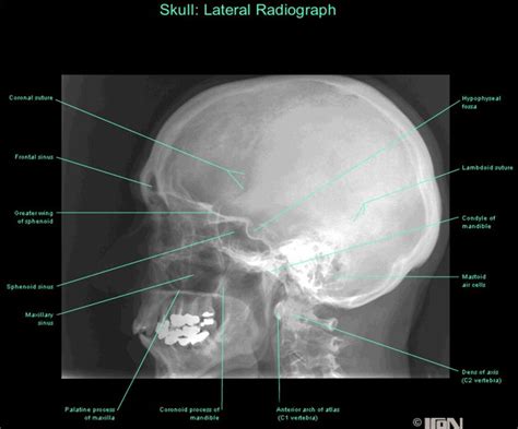 Lateral radiograph skull | Skull anatomy, Anatomy, Anatomy images