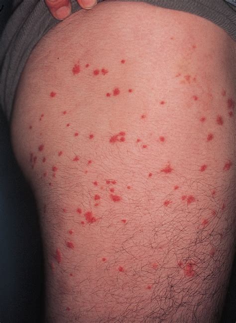 Pruritic Urticarial Papules of the Thighs and Groin | Allergy and ...