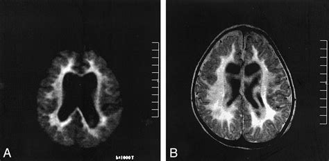 Metachromatic Leukodystrophy. Causes, symptoms, treatment Metachromatic ...