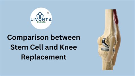 Comparison between Stem Cell and Knee Replacement