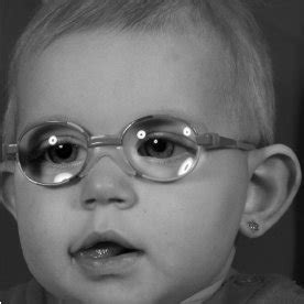 Aphakic glasses in a paediatric patient operated for bilateral ...