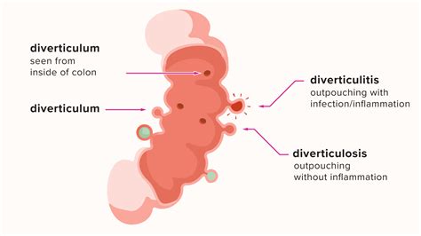 Diverticular Disease