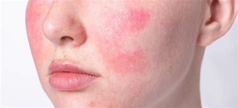 Rosacea Treatment: 6 Natural Remedies to Use - Dr. Axe