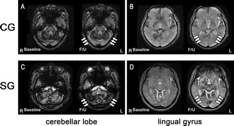 MRI signal changes in the cerebellar lobes and lingual gyri in the CG ...