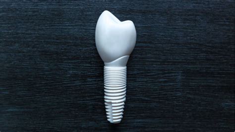 Ceramic Dental Implants in Indianapolis, IN