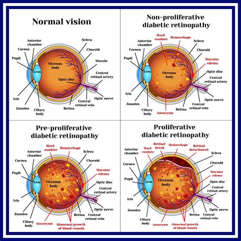 Diabetic Retinopathy Stages