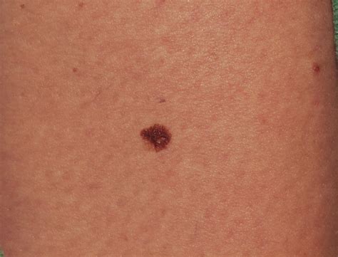 bestway: Melanoma Symptoms, Signs, Diagnosis, Staging, Prognosis and ...