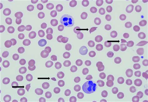 Hemolytic Anemia Peripheral Smear