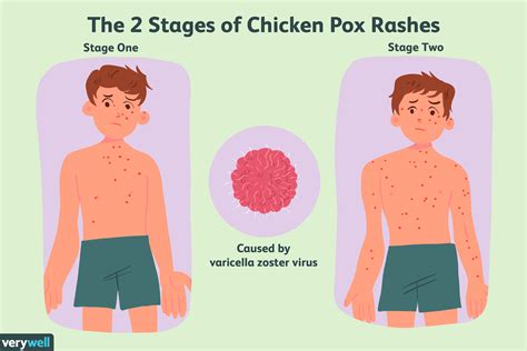 Chickenpox: Overview and More