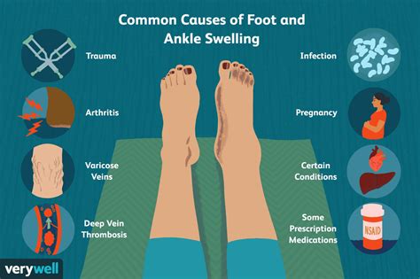 Common Causes of Foot and Ankle Swelling