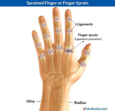 Sprained Thumb or Skier's Thumb|Types|Causes|Signs|Symptoms|Treatment ...