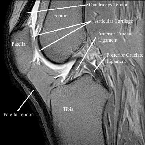 Radiology Anatomy Images : Patellar articular cartillage in MRI Knee ...