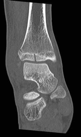 Tillaux fracture | Radiology Reference Article | Radiopaedia.org