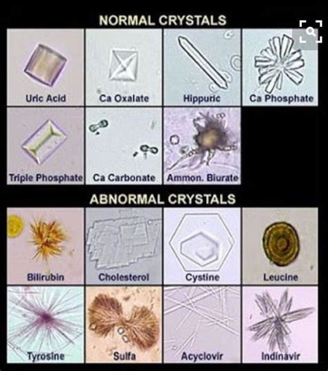 What are the types of Crystals found in Urine?