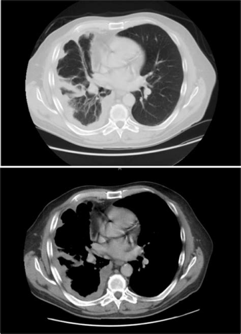 Malignant Pleural Mesothelioma | Department of Cardiothoracic Surgery ...