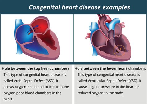 Congenital Heart Diseases